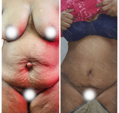 tratment-tummy-tuck