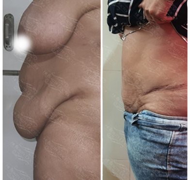 tummy-tuck-treatment
