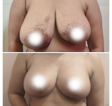 Breast Augmentation - P01a01