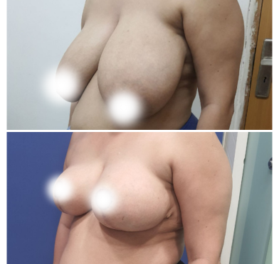 Breast Augmentation - P02a01