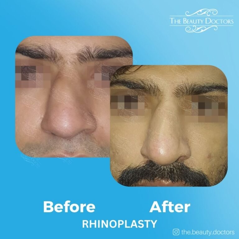 Rhinoplasty-15