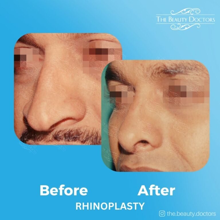 Rhinoplasty-7
