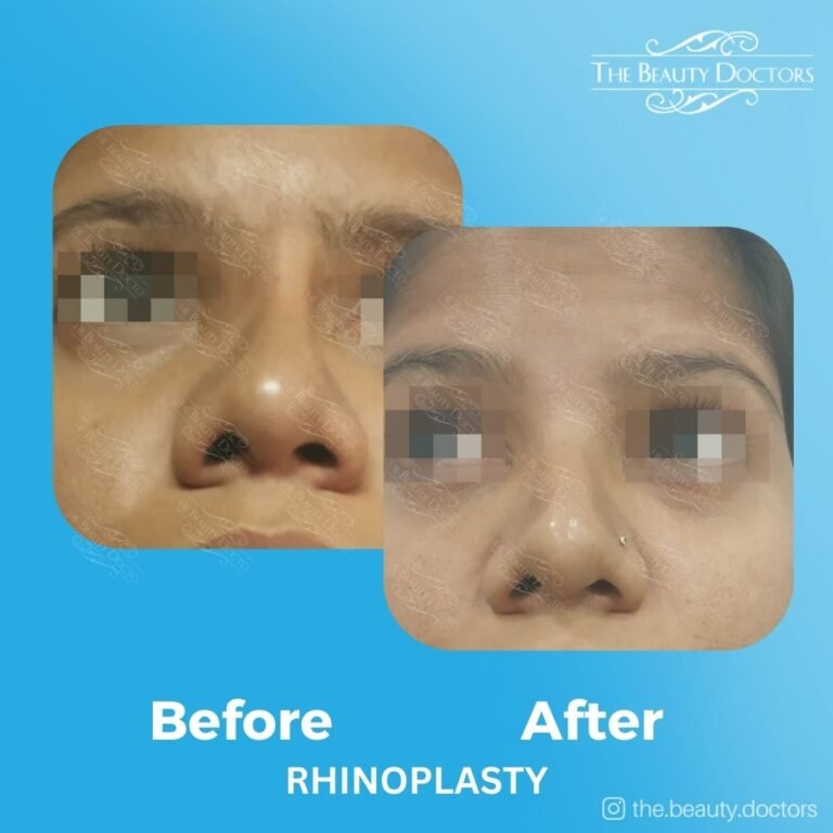 Rhinoplasty-8